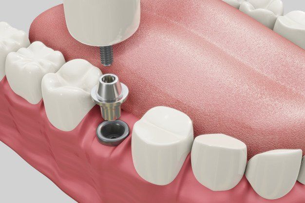 um close de um dente com um implante dentário.