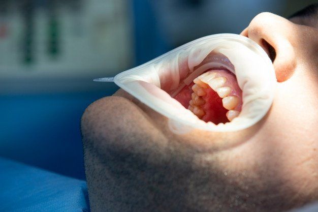uma pessoa está tendo seus dentes examinados por um dentista.