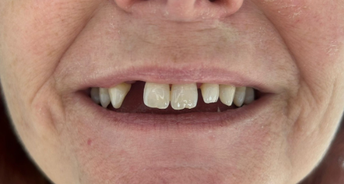 Vorher Nachher Veneers