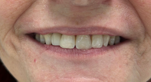 Vorher Nachher Veneers