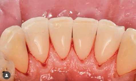 Vorher-Nachher Zähne Mundhygiene