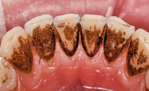 Vorher-Nachher Zähne Mundhygiene