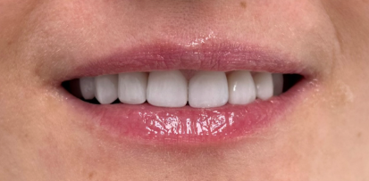 Vorher-Nachher Zähne 