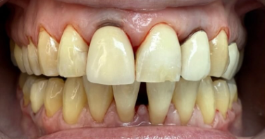 Vorher-Nachher Zähne 