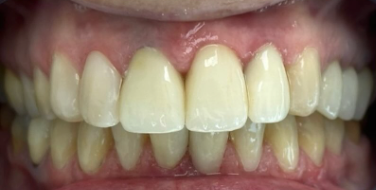 Vorher-Nachher Zähne 