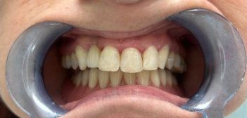 Vorher Nachher Veneers