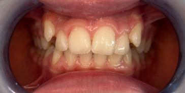 Vorher-Nachher Zähne Vorher-Nachher Zähne 