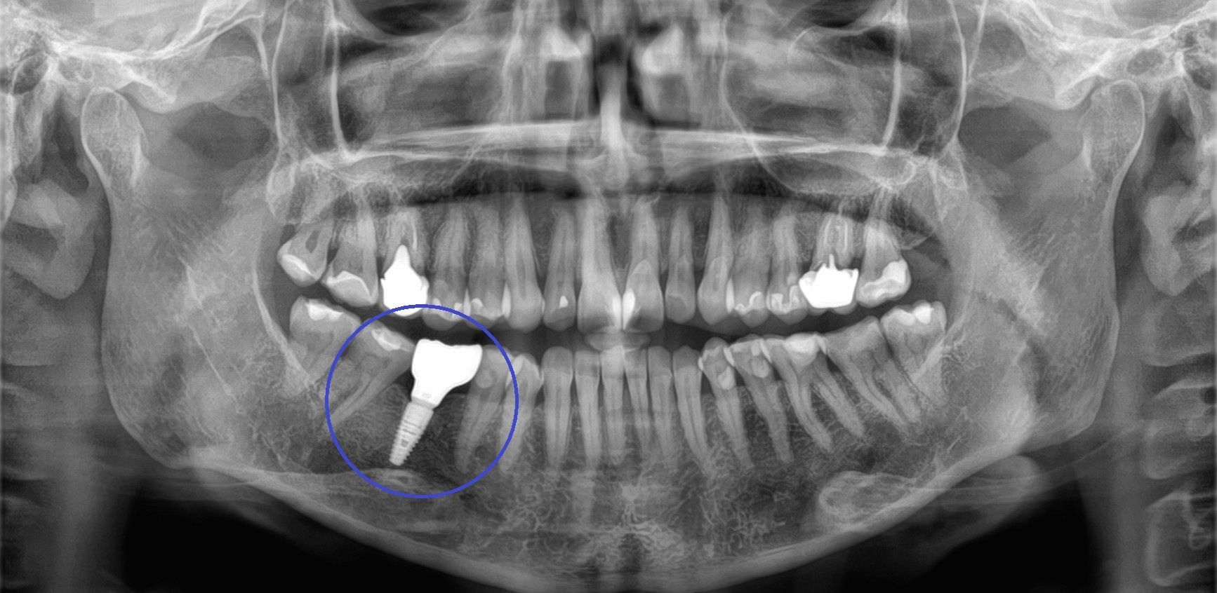 Implantat panoramaroentgen-moedling