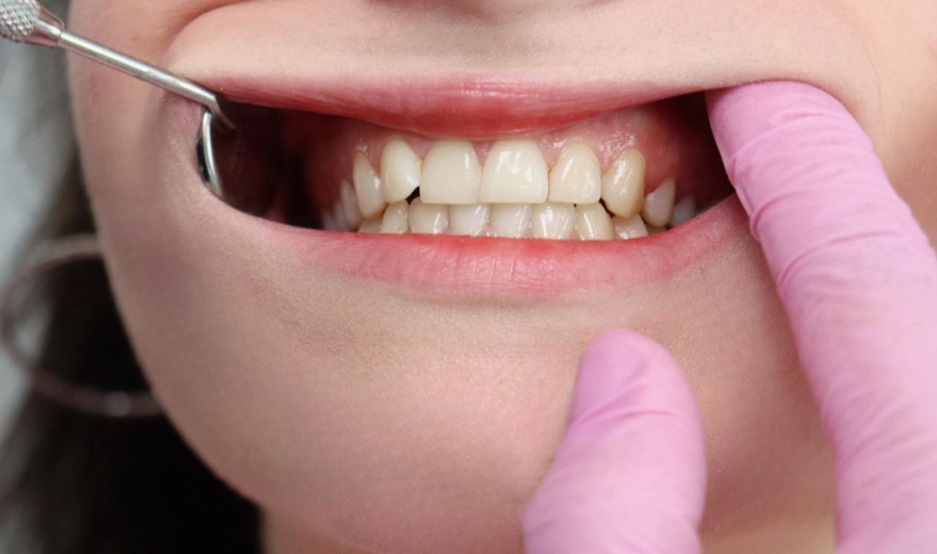 Korrektur des Zahnfleischs in Mödling