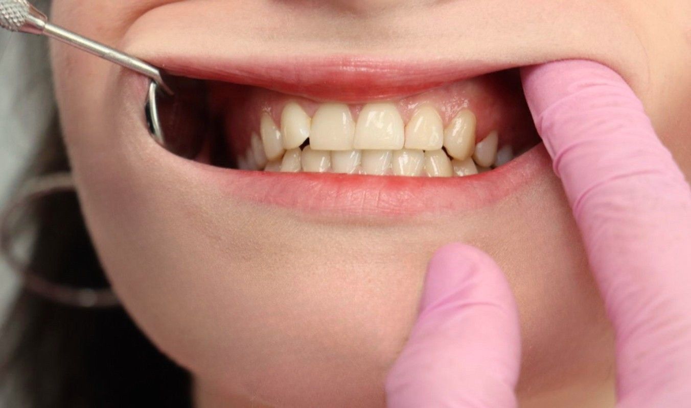 Nahaufnahme von Zähnen, die mit einem Zahnspiegel und einem behandschuhten Finger untersucht werden. Rosa Handschuhe und Lippen sind sichtbar.