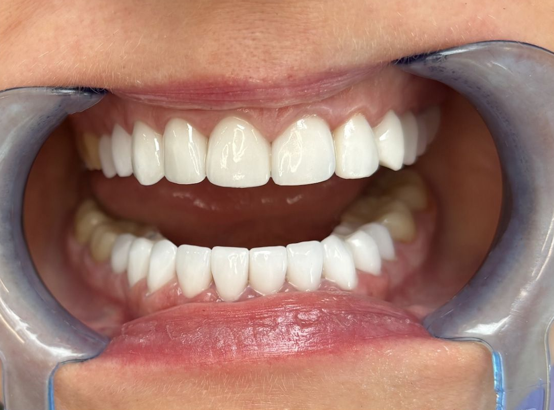 Vorher Nachher Veneers