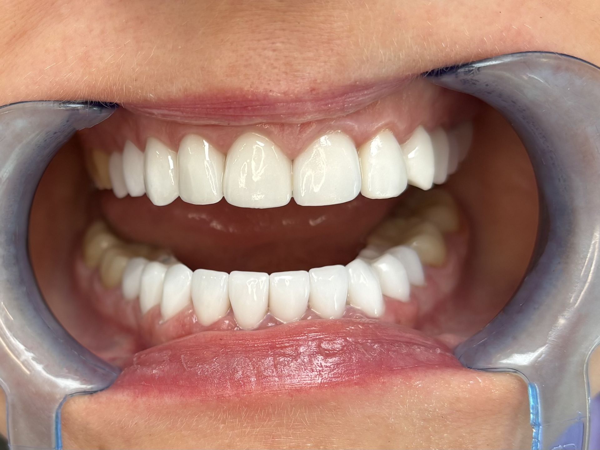 Zahnaesthetik Veneers Frontzaehne-moedling