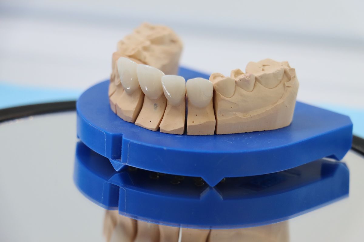zahnersatz kronen wiener neudorf