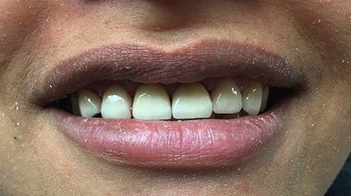 patient after crown treatment