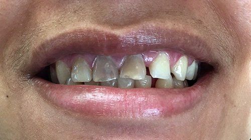 patient before treatment with discolor teeth