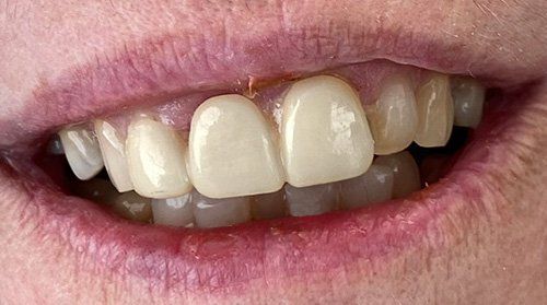 patient after teeth treatment with a new smile