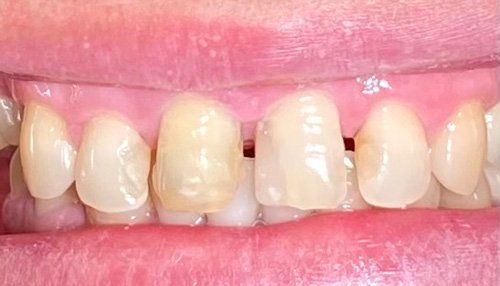 patient before treatment with some decay and gaps