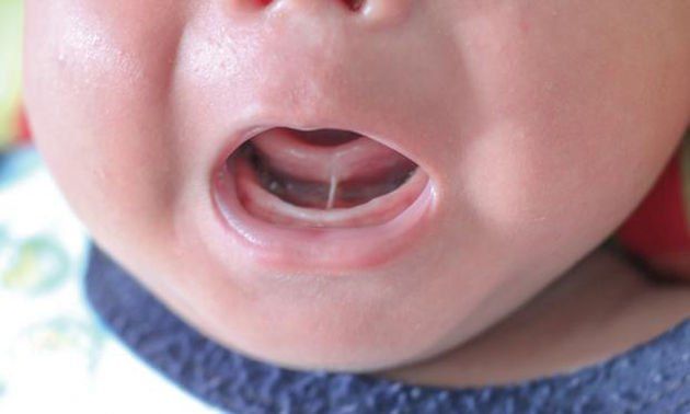 Increase in Tongue Tie Operations Outpaces Evidence