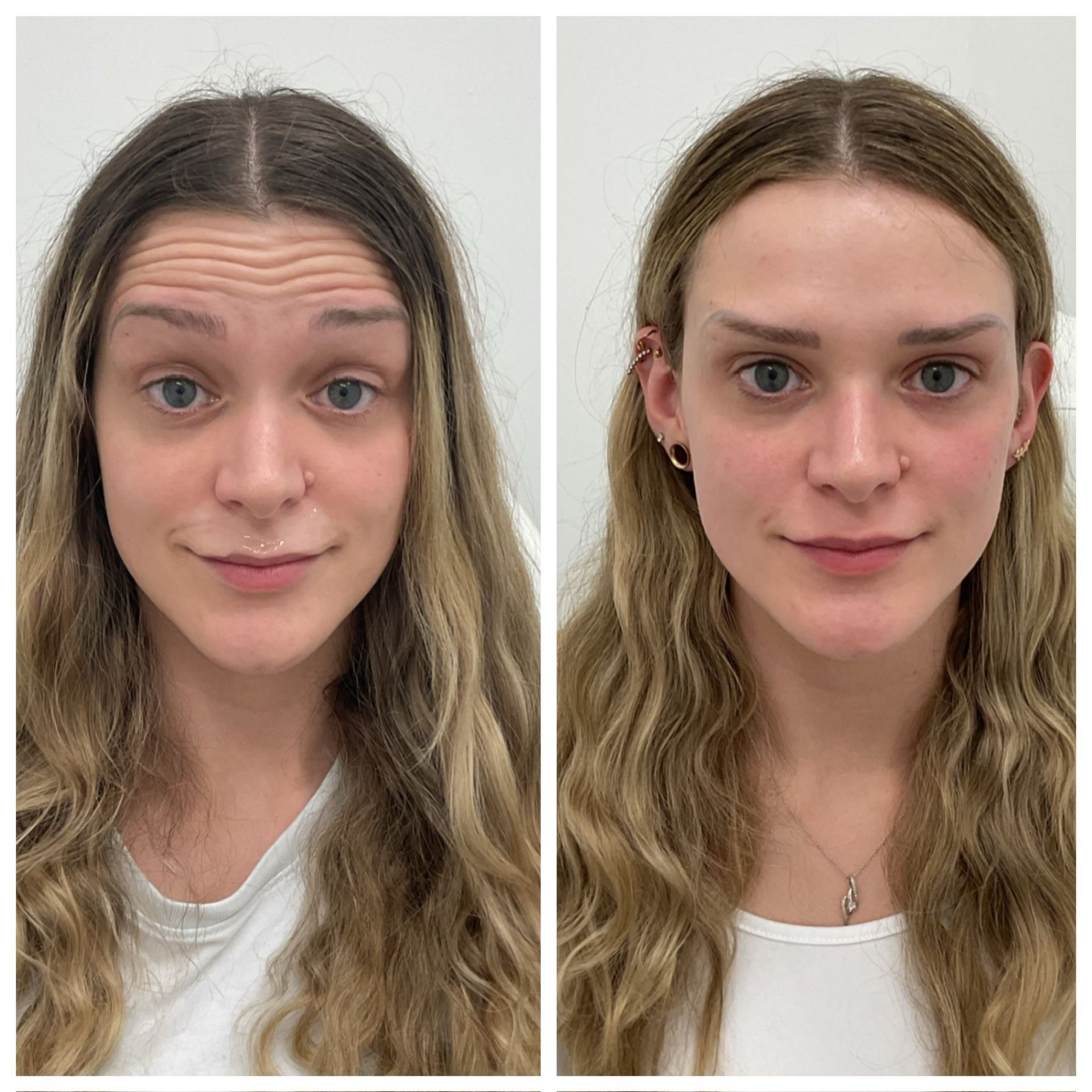 Side-by-side photos of a woman. The left shows forehead wrinkles; the right shows smoother skin.