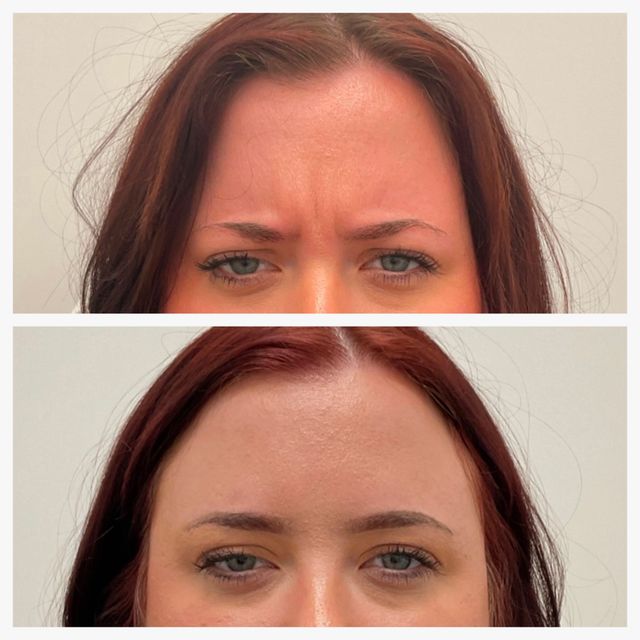 glabellar frown 11s lines botox treatment before and after