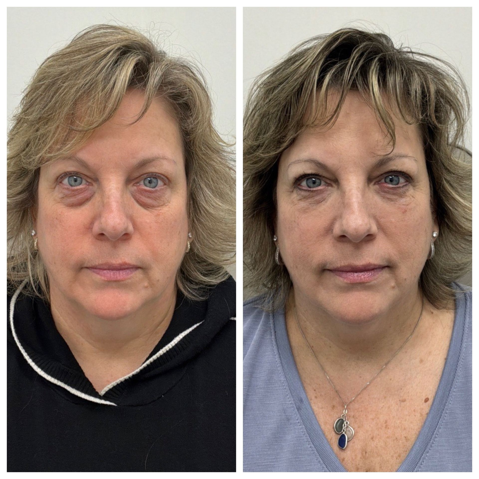 before and after of under-eye filler in CT