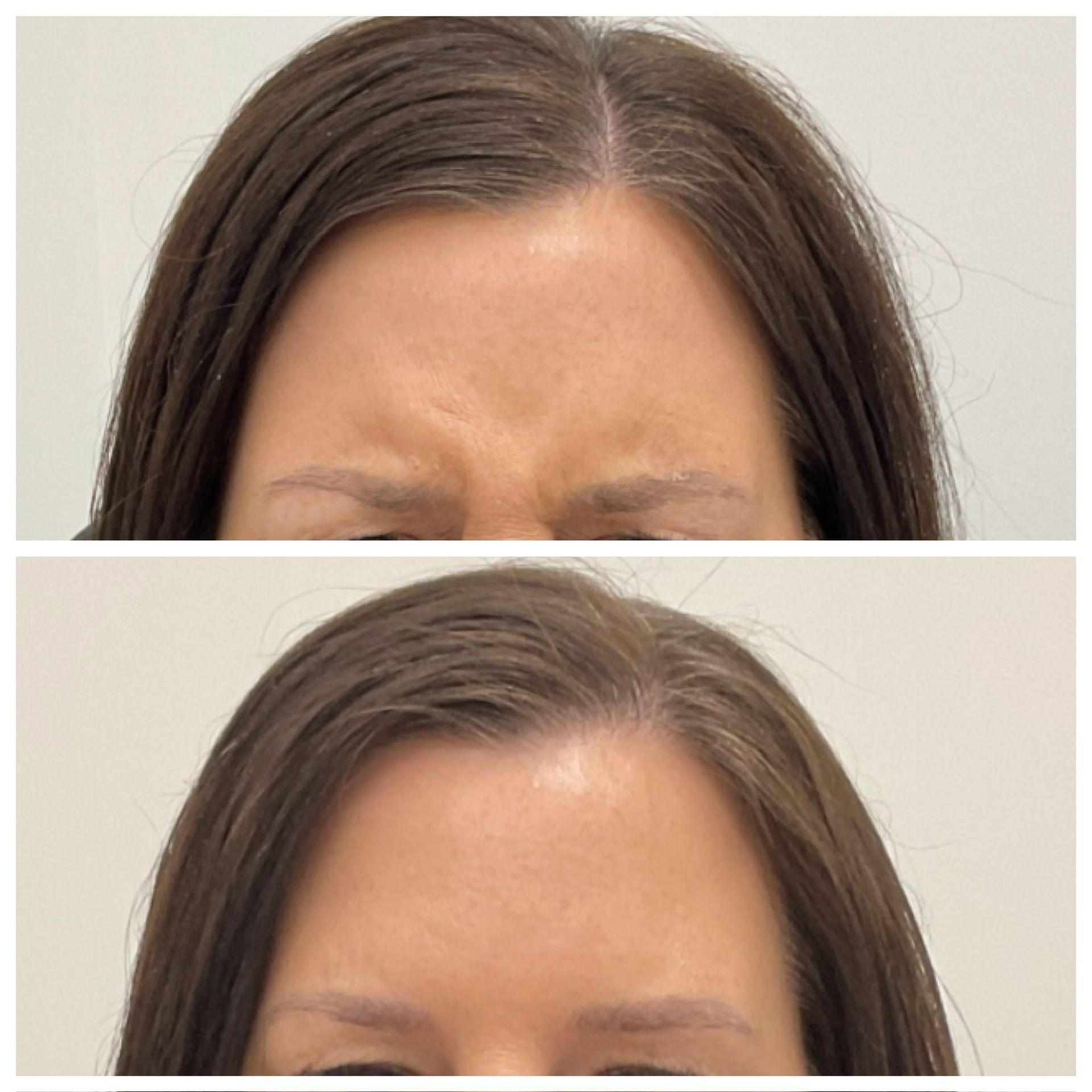 A before and after photo of a woman 's forehead.