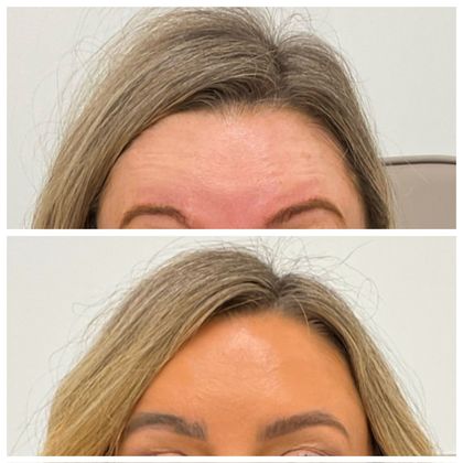 botox at forehead before and after