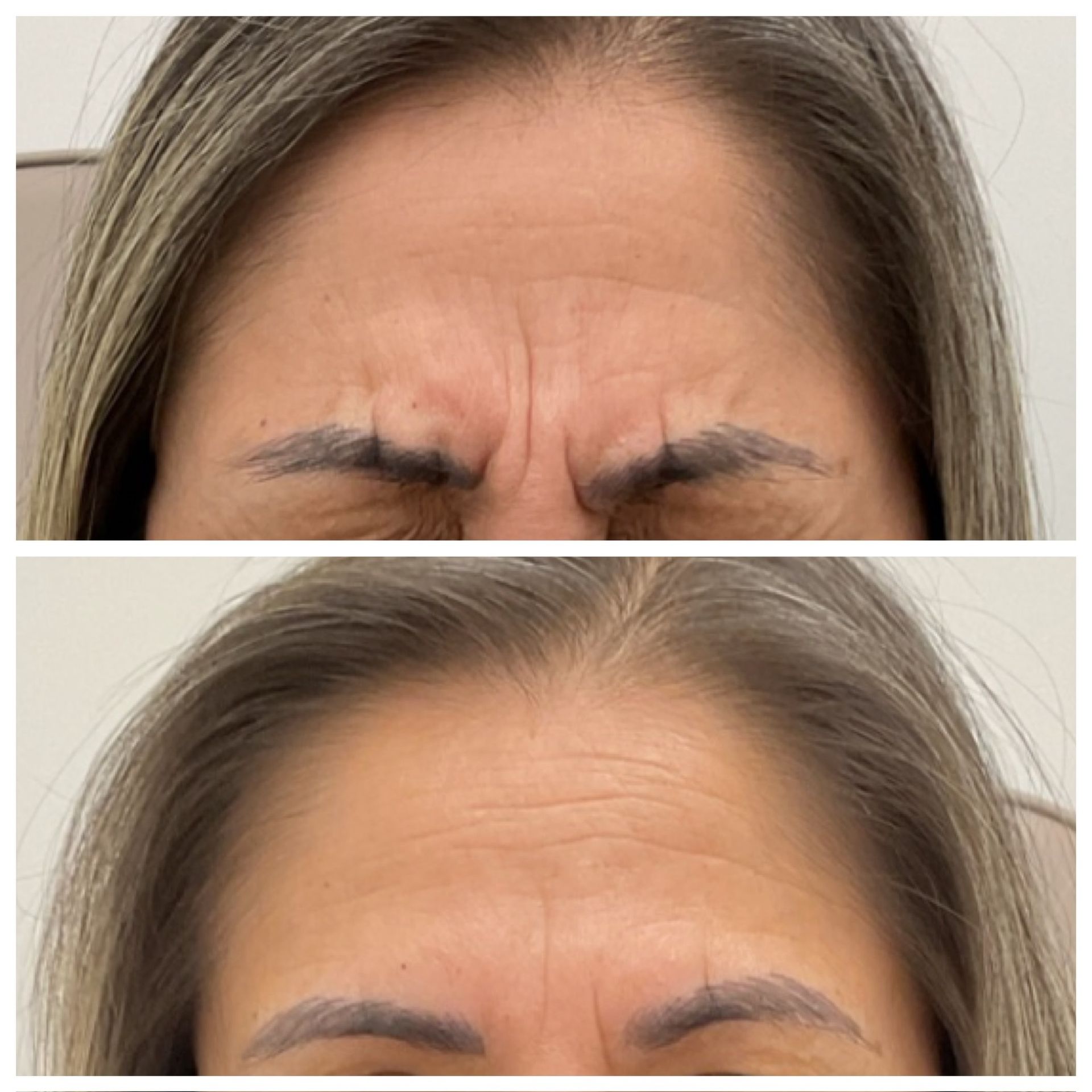A before and after photo of a woman 's forehead with wrinkles.