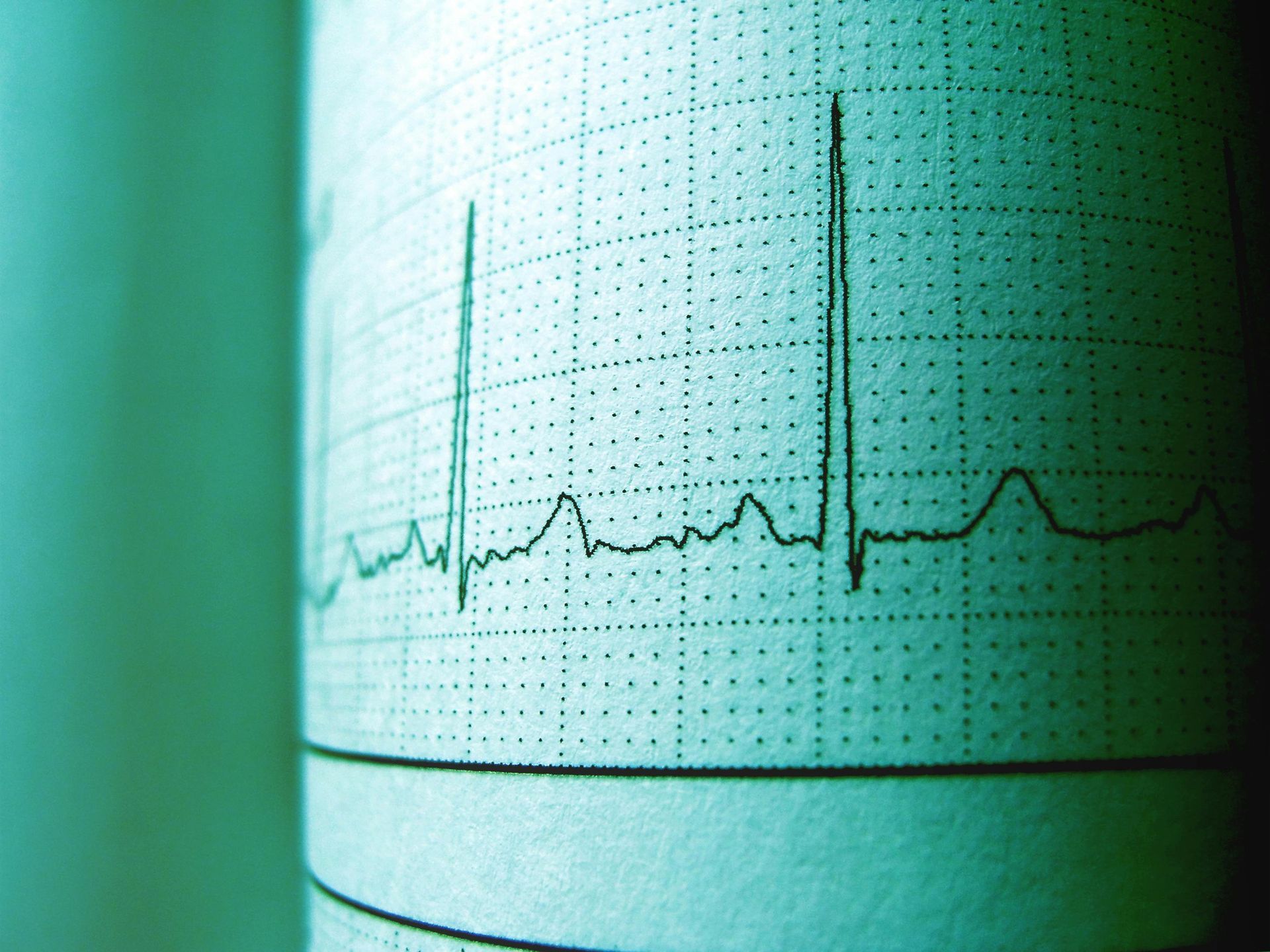 An electrocardiogram (ECG) printout showing heart rate and rhythm in a blue-green hue.