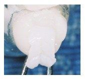 inlays and onlay in Belmont