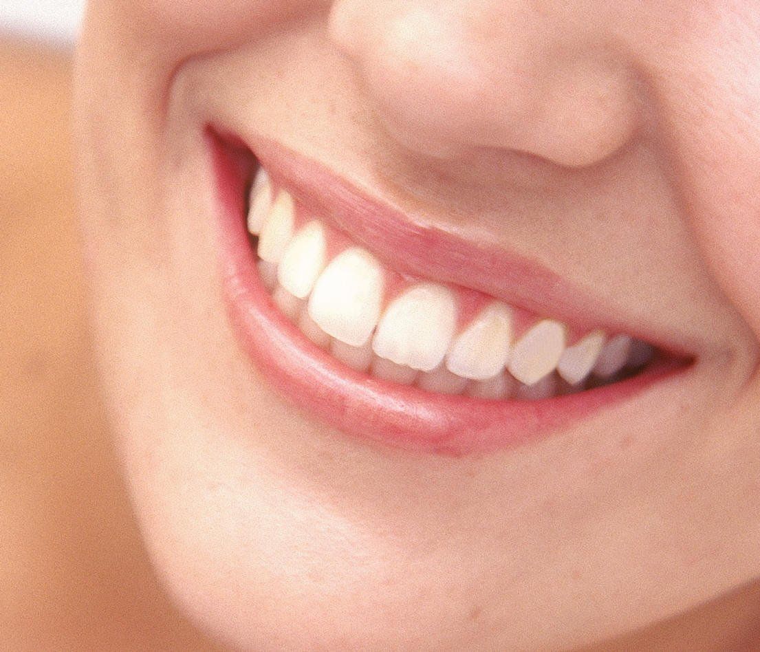 dental veneers cosmetic dentist in Belmont