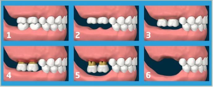 Mobilità dentale: la ricerca dell’antagonista mancante con conseguente perdita del dente