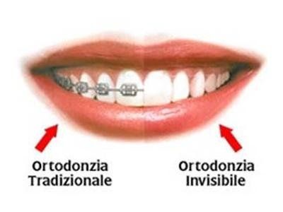 ortodonzia invisalign