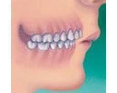 sporgenza denti inferiori