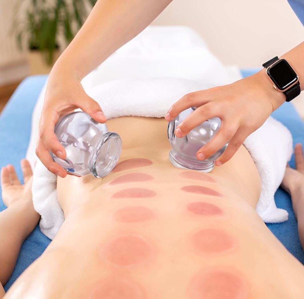 A Person Is Getting A Cupping Treatment On Their Back — Pin Point Remedial Massage In Lammermoor, QLD