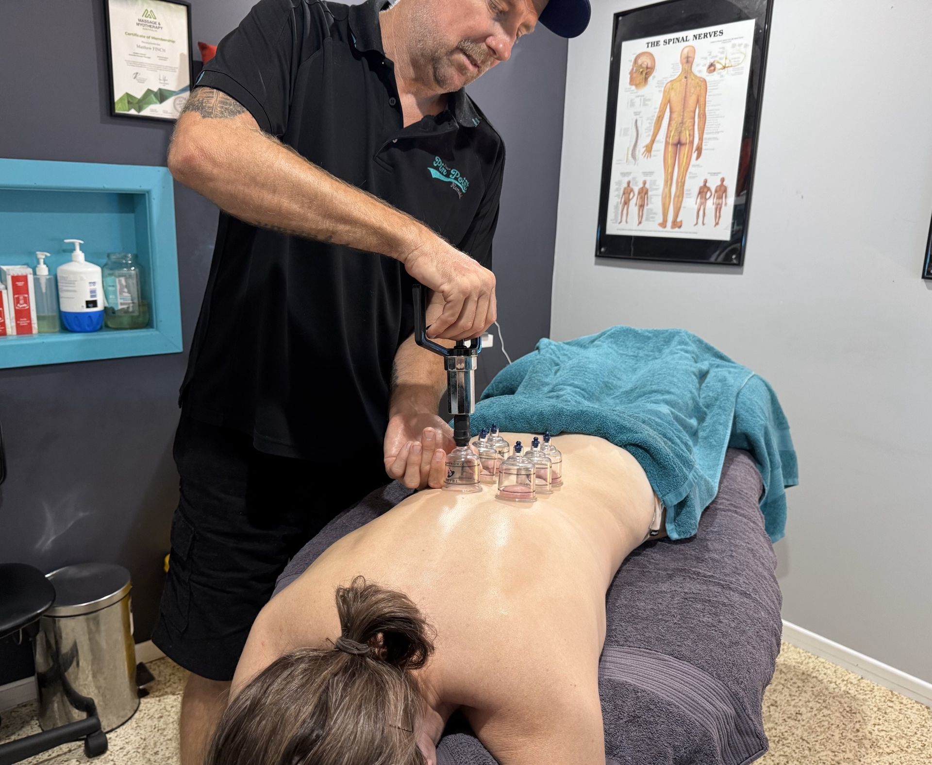 A Person Is Getting A Cupping Treatment On Their Back — Pin Point Remedial Massage In Lammermoor, QLD