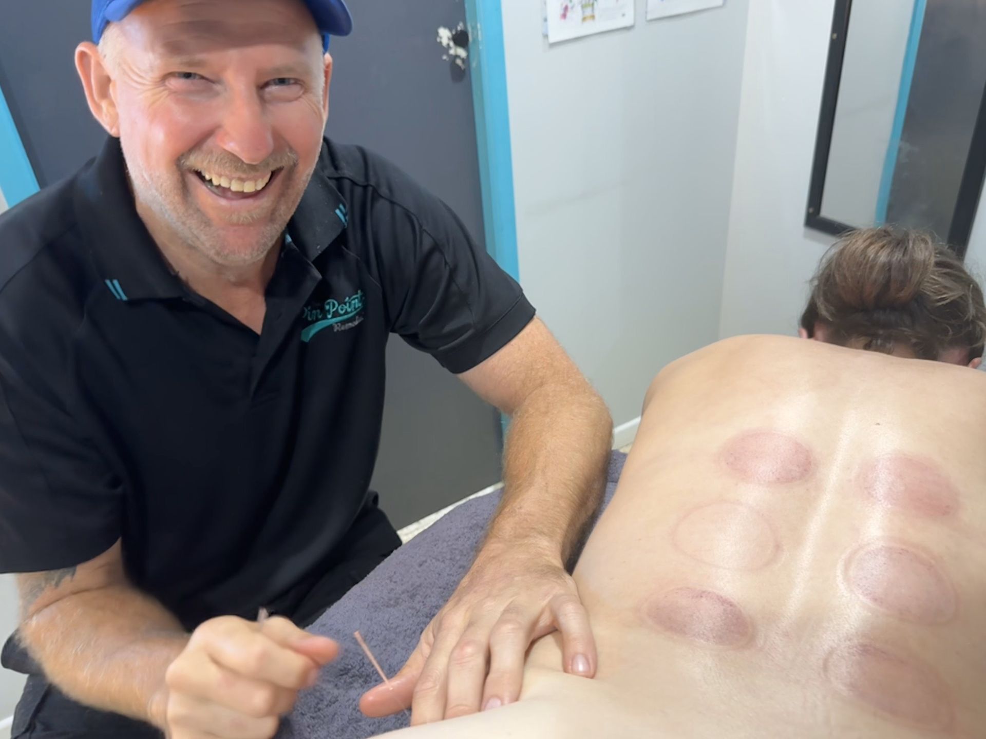 A Person Receiving A Cupping Session Massage — Pin Point Remedial Massage In Lammermoor, QLD