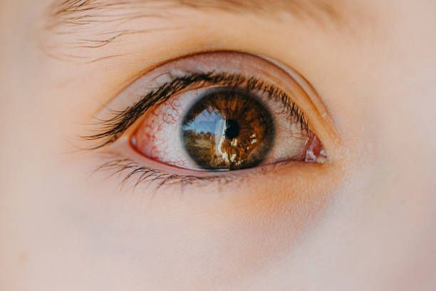 Close-up of a brown eye, visible red veins, reflecting light.