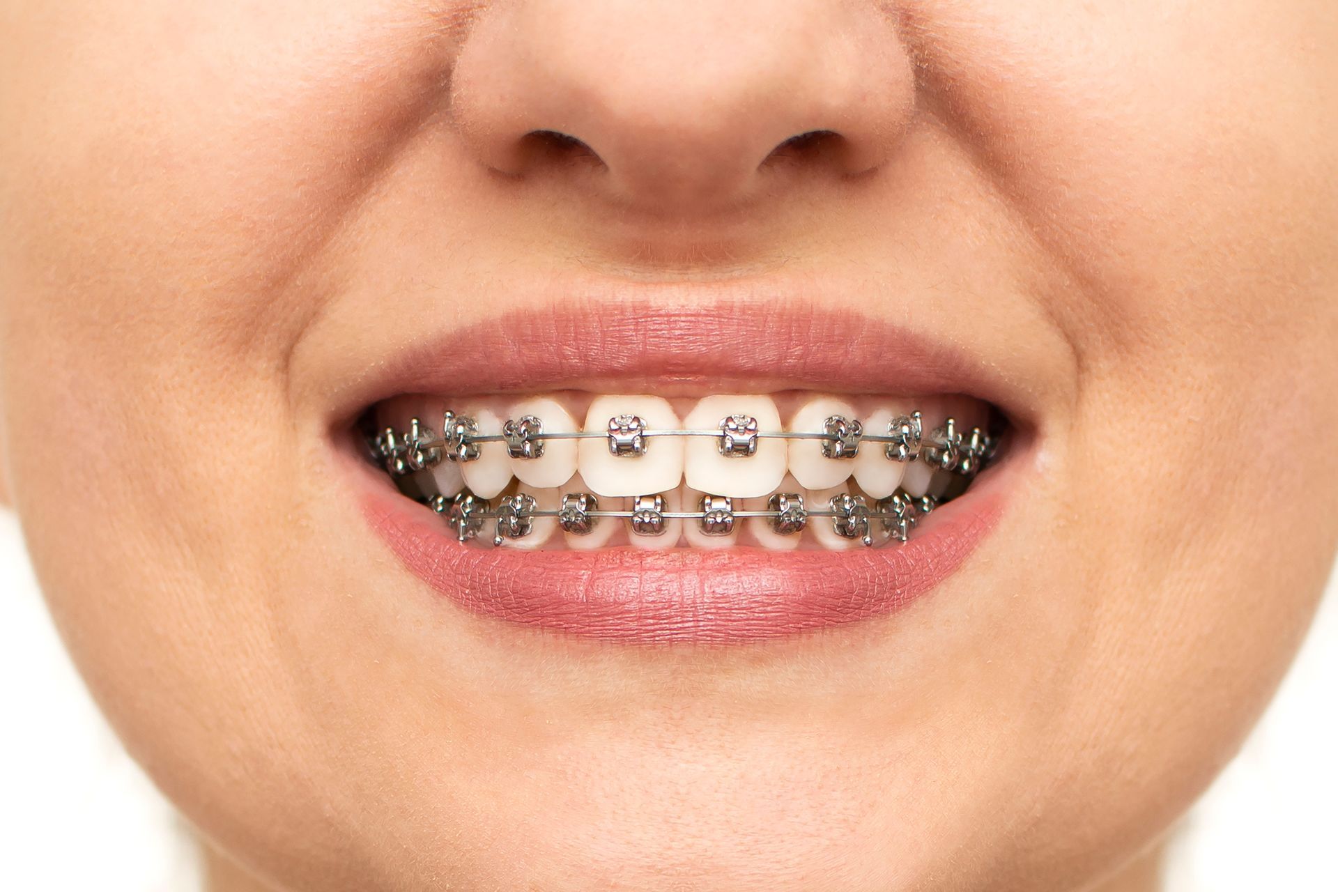 Closeup of a smiling healthy female mouth with metal braces