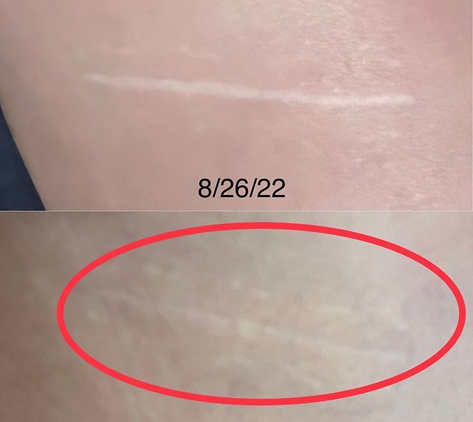 ACL Repair Scar