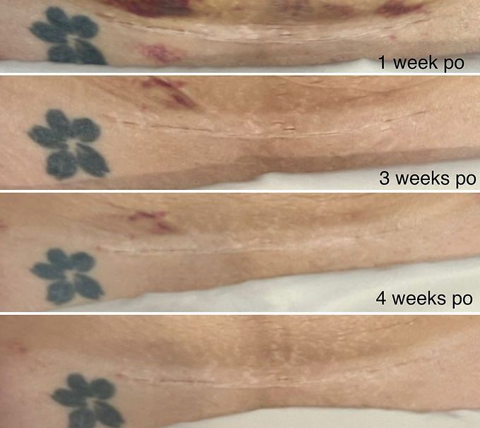 C-section Scar Treatment