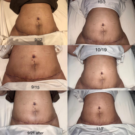8 Week Transformation Tummy Tuck & Lipo 360 with Fibrosis