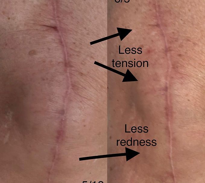 Knee Replacement Scar Treatment Three Week Transformation