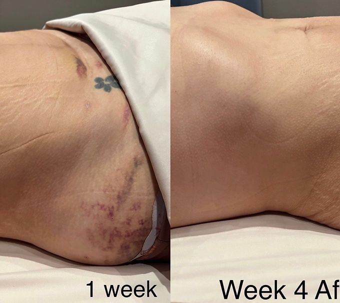 Laser Lipo With C-section Scar