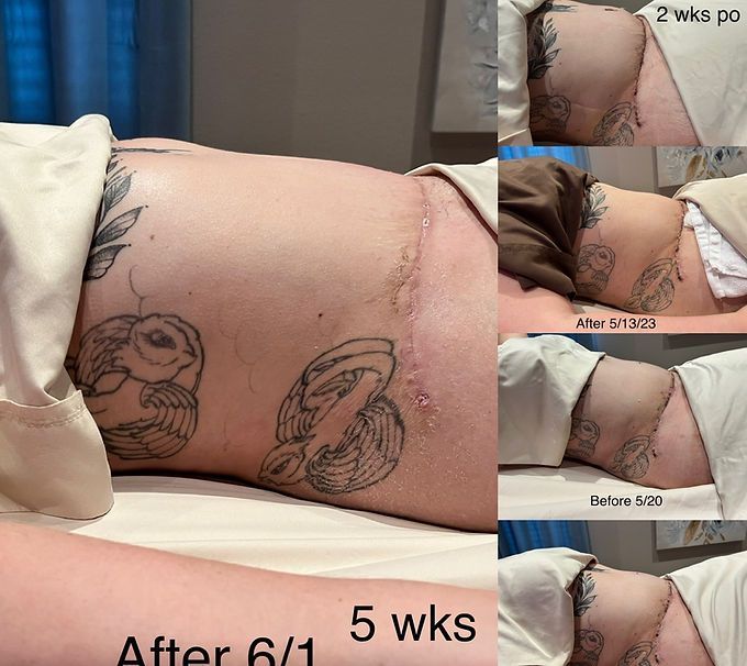 Tummy Tuck Scar Transformation