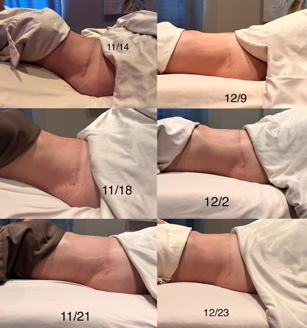 8 Week Transformation Tummy Tuck & Lipo 360 with Fibrosis