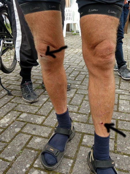 Foto von einem Paar Männerbeinen. Auf dem einen Knie und auf dem anderen Bein unten sind kleine Wunden zu sehen