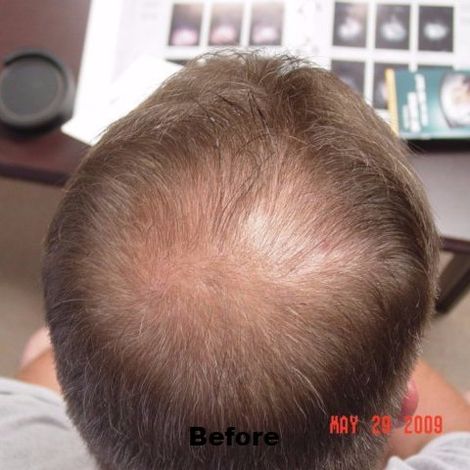 Generic form of propecia