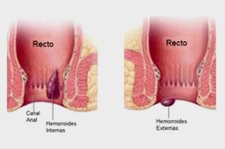 DR. GERARDO GONZÁLEZ COLOPROCTÓLOGO Y CIRUJANO GENERAL