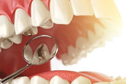  Dr. César San Martín Treviño Cirujano Dentista  -Consejos para evitar las caries